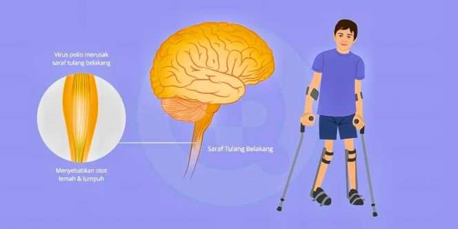 
 Anak terkena penyakit Polio.(ilustrasi)